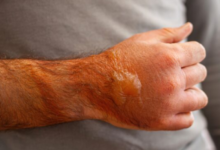 Burn Injuries from Accidents: Understanding Your Path to Recovery