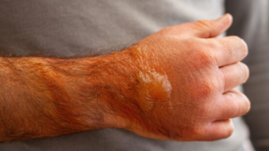 Burn Injuries from Accidents: Understanding Your Path to Recovery
