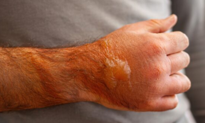 Burn Injuries from Accidents: Understanding Your Path to Recovery